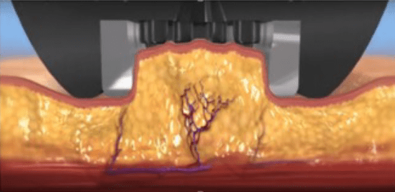 ミニFXの脂肪破壊メカニズムのステップ1