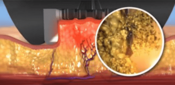ミニFXの脂肪破壊メカニズムのステップ3