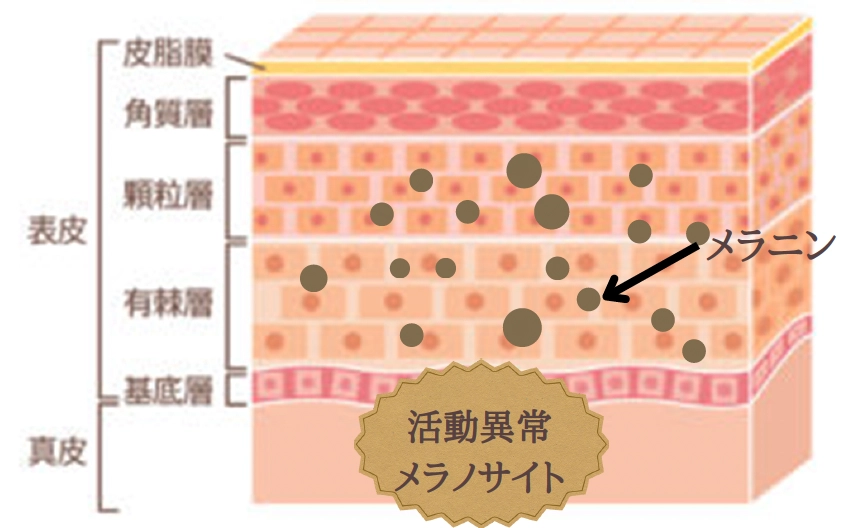 肝斑：メラノサイトが活動異常状態、メラニンが充満している