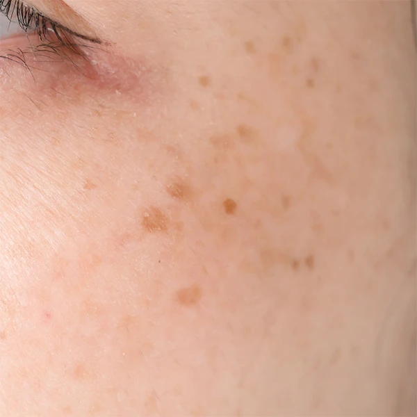 老人性色素斑と肝斑