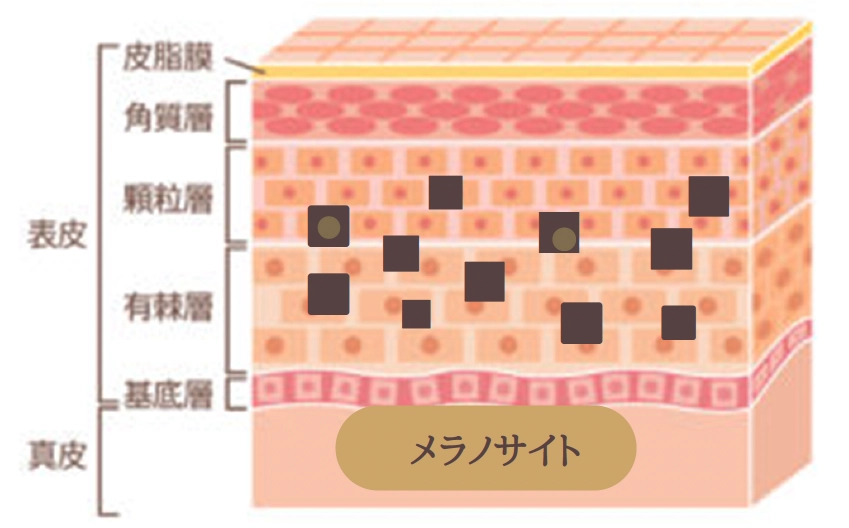 シミ（老人性色素斑）：メラニンを蓄えている部屋（細胞）が増えている状態