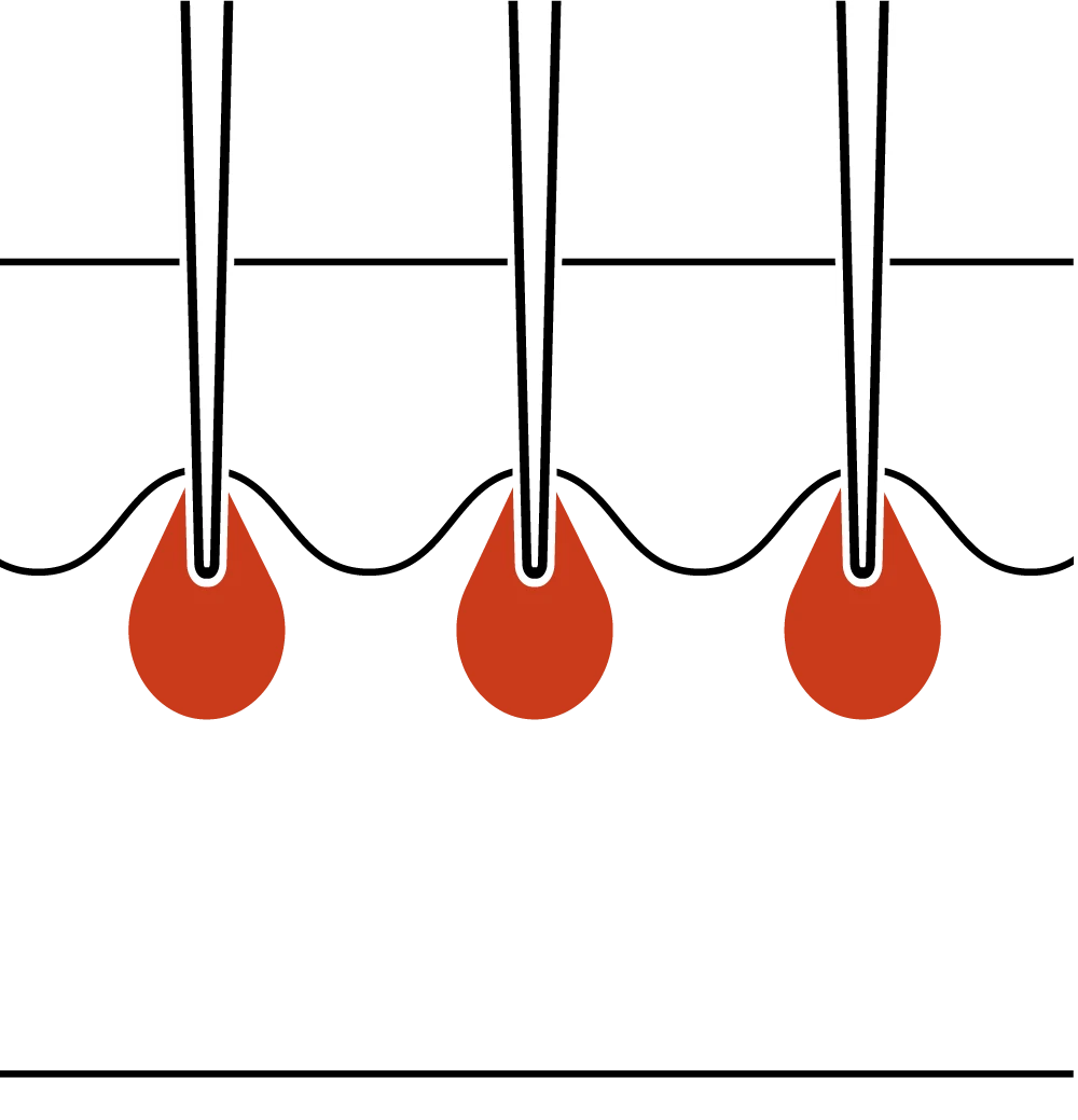Non Selective Coagulation with CW