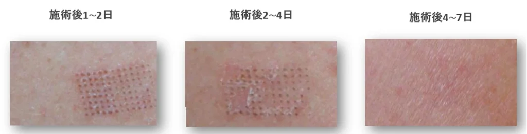 エンディメッド PROMAX