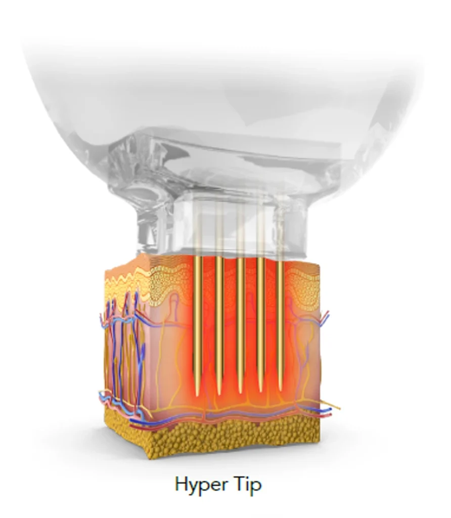 エンディメッド PROMAX