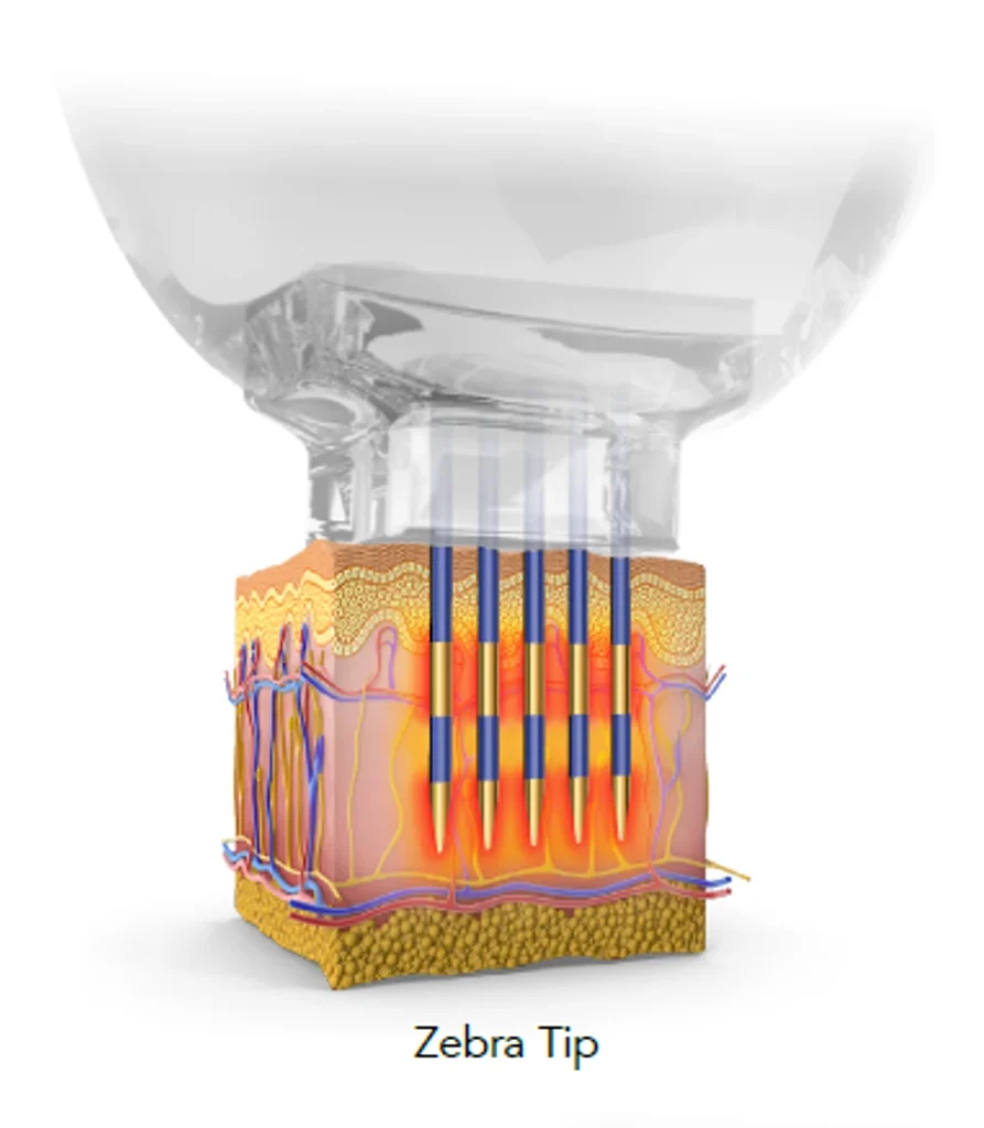 エンディメッド PROMAX
