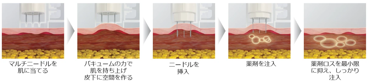 エクソヒーラーSBプラス（水光注射）