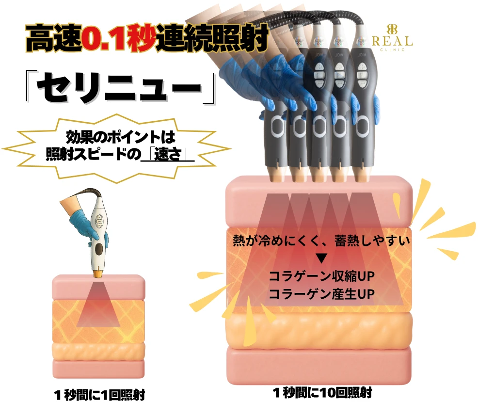 セリニュー 効果のポイントは照射スピードの速さ