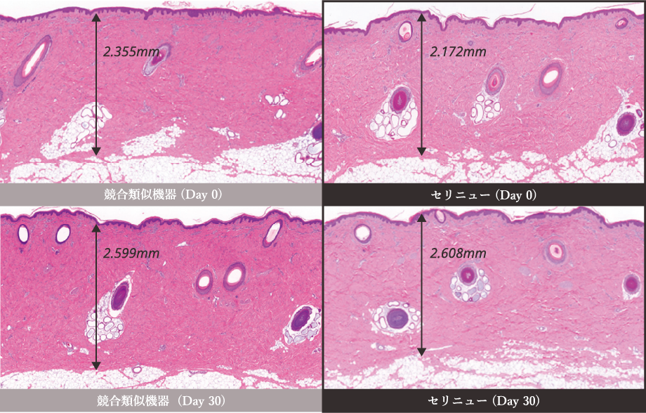 セリニューは同等のデバイスと比較して 真皮の厚さが2倍改善