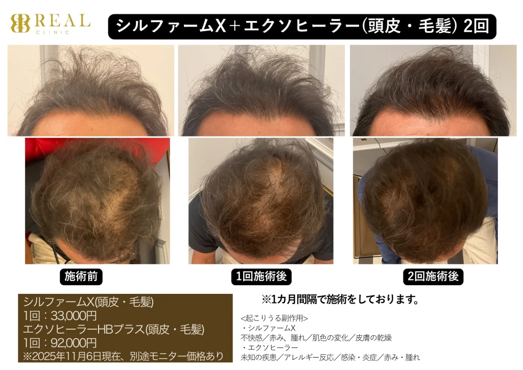 メンズ美容ビフォーアフター - シルファームＸ+エクソヒーラー（頭皮・毛髪）2回