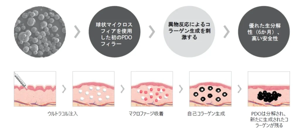 ウルトラコルのメカニズム。1. ウルトラコル注入、2. マクロファージ吸着、3. 自己コラーゲン生成、4. PDOは分解され、新たに生成されたコラーゲンが残る